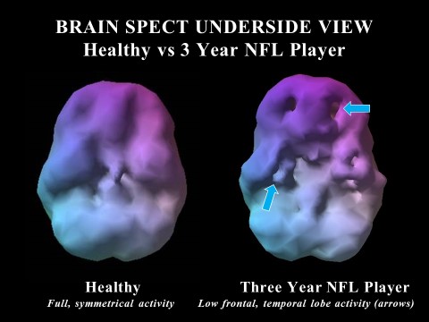 SPECT brain scans