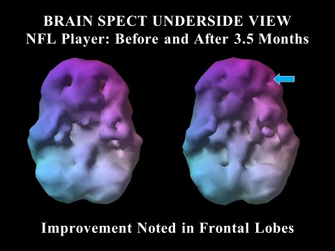 SPECT brain scans