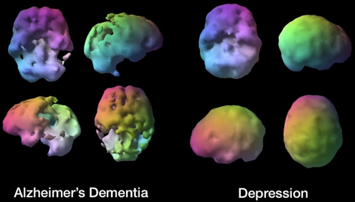 Representative brain SPECT scans