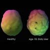 Brain image of healthy person versus daily user of marijuana 